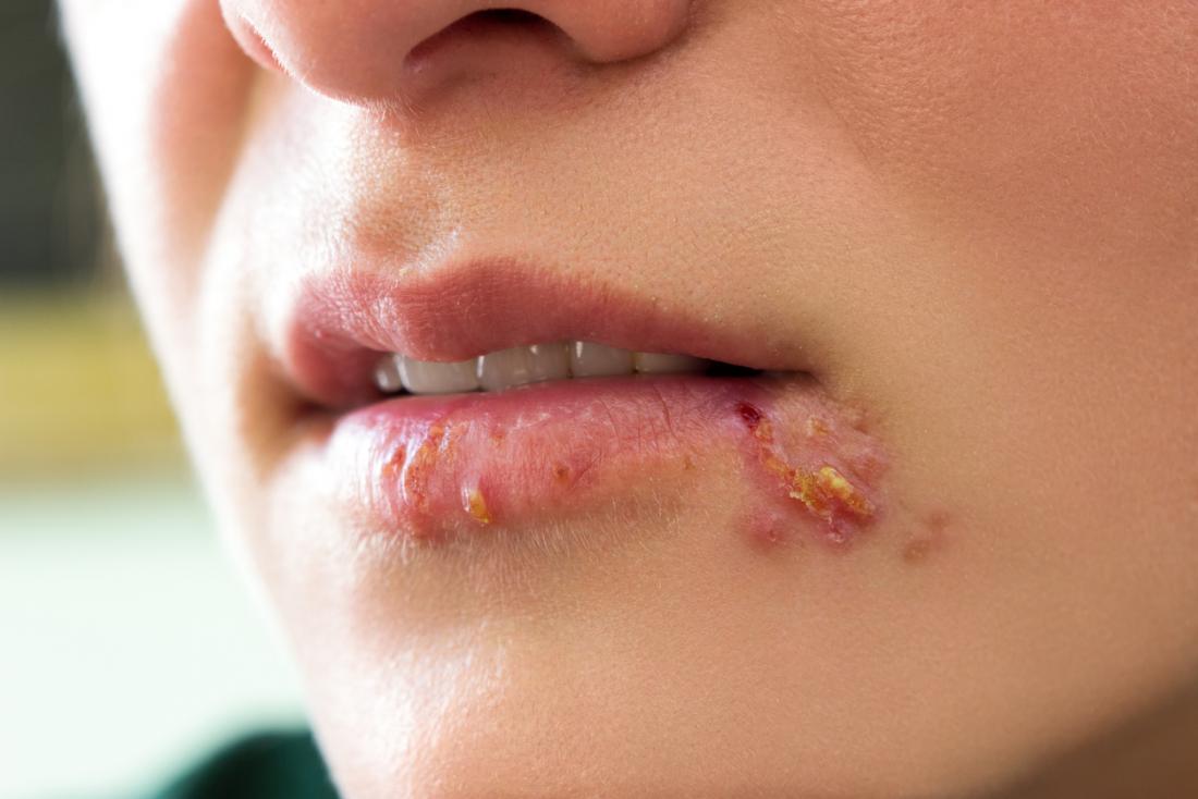genial herpes treatment